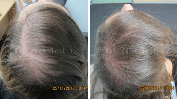 Success Story Alert New Female Hair Loss Treatment Entry