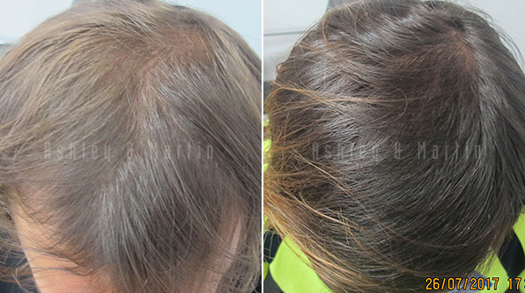 Significant Increase in Hair Density for Ashley and Martin Client | Ashley  and Martin Sydney